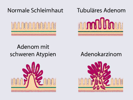 Entstehung von Darmkrebs aus einem Polypen – Adenom-Karzinom-Sequenz